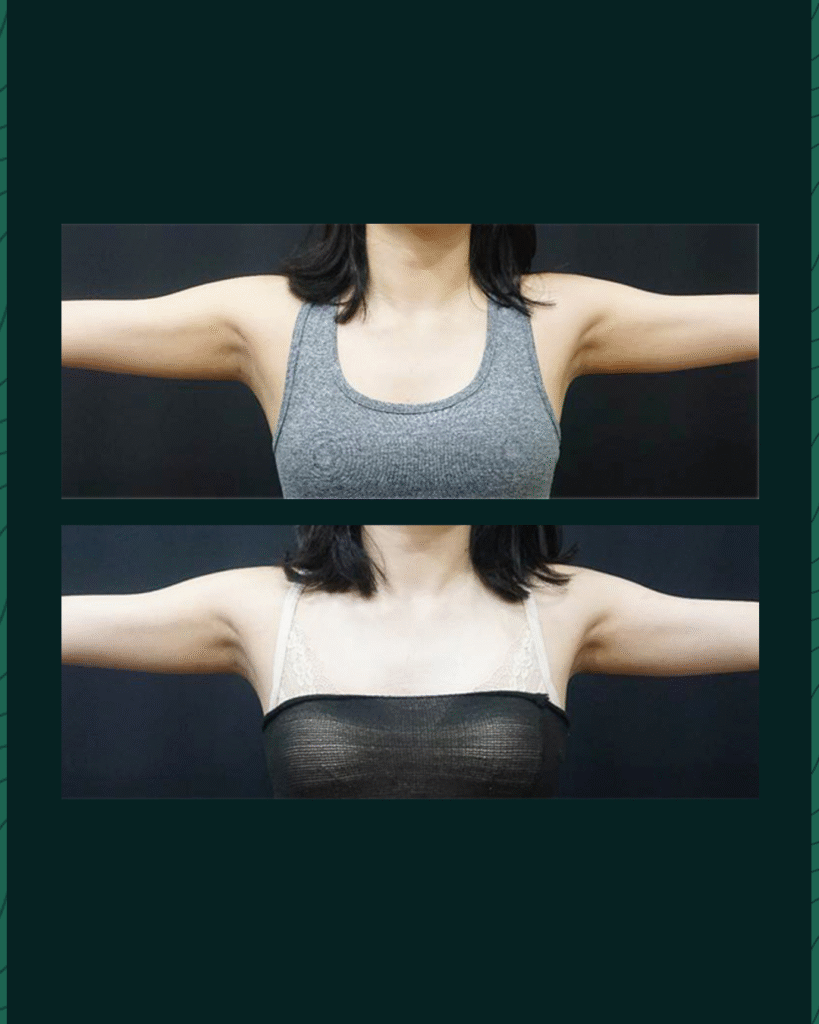 HIFU Device - Before After