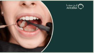 احسن انواع حشو الاسنان المستخدمة في عيادات ابن سينا