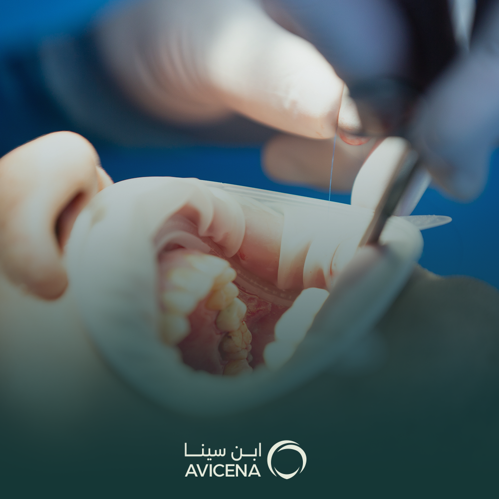 افضل انواع حشوة الاسنان