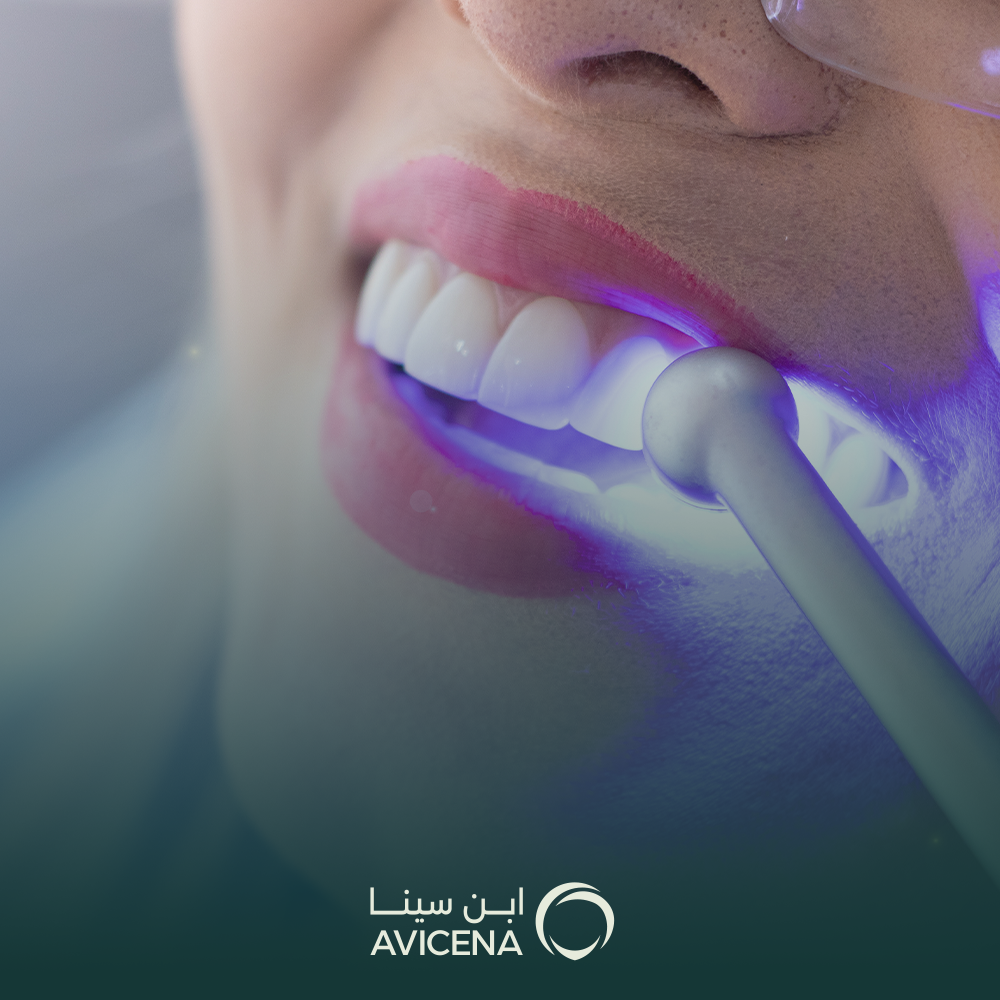 عروض تبييض الاسنان