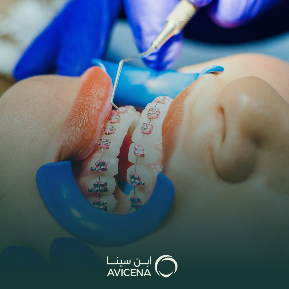 عروض تركيب تقويم اسنان