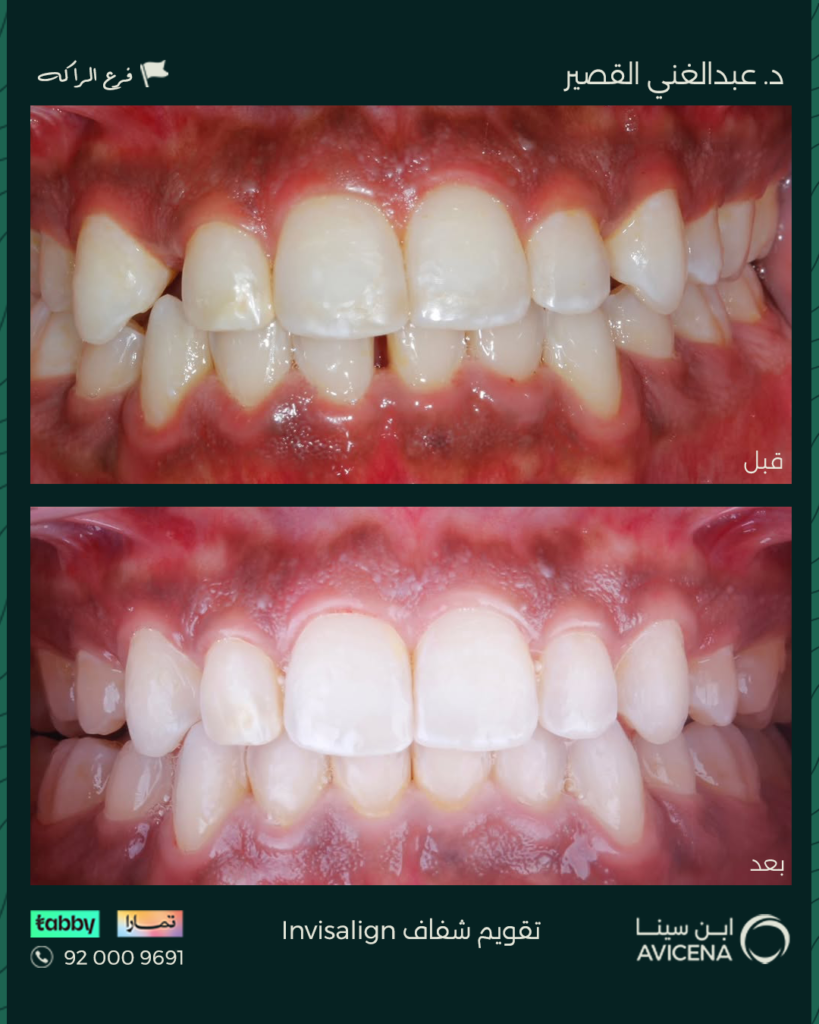 د. عبدالغني زياد القصير - قبل وبعد
