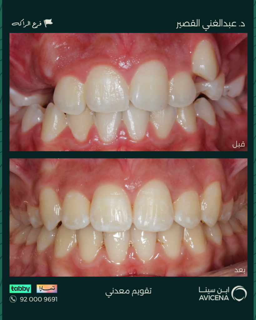 د. عبدالغني زياد القصير - قبل وبعد