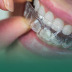 ما الفرق بين تقويم الأسنان المعدني والتقويم الشفاف؟