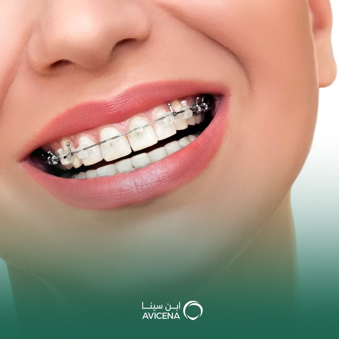 تقويم أسنان بدون زيارات كثيرة