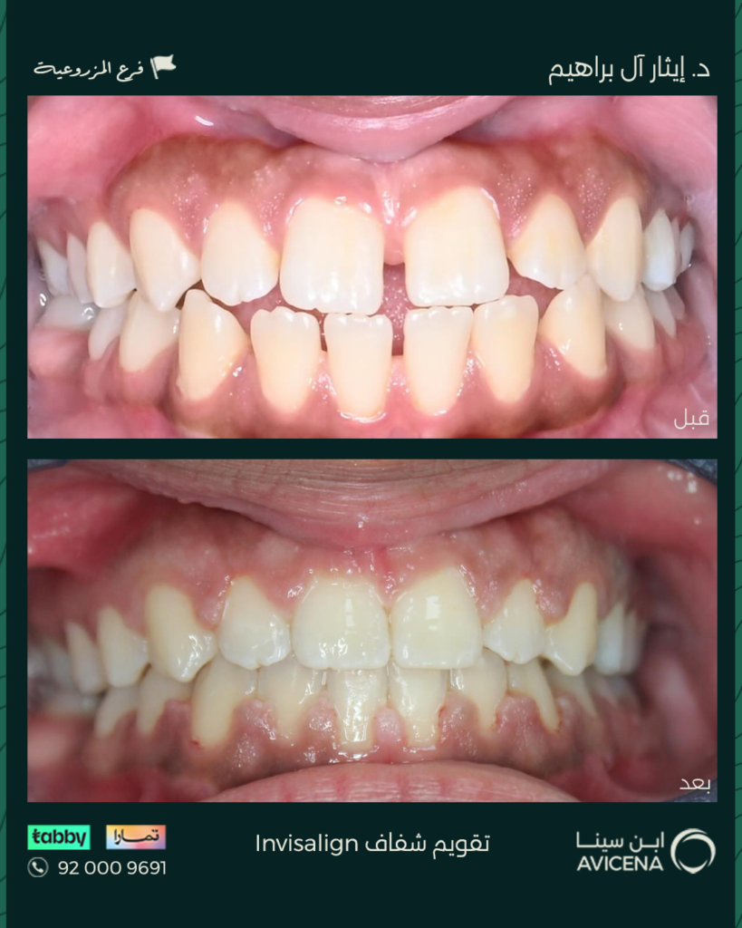 د. إيثار بشير آل إبراهيم - قبل وبعد