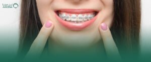 أهمية اختيار استشاري تقويم الأسنان الراكة