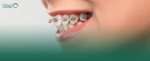 اكتشف تجربتي مع تقويم أسنان الراكة