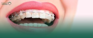 تقويم أسنان سريع النتائج ولماذا يبحث عنه الكثيرون