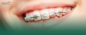 خبراء تقويم الأسنان في عيادات ابن سينا