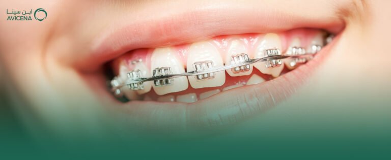 خبراء تقويم الأسنان في عيادات ابن سينا