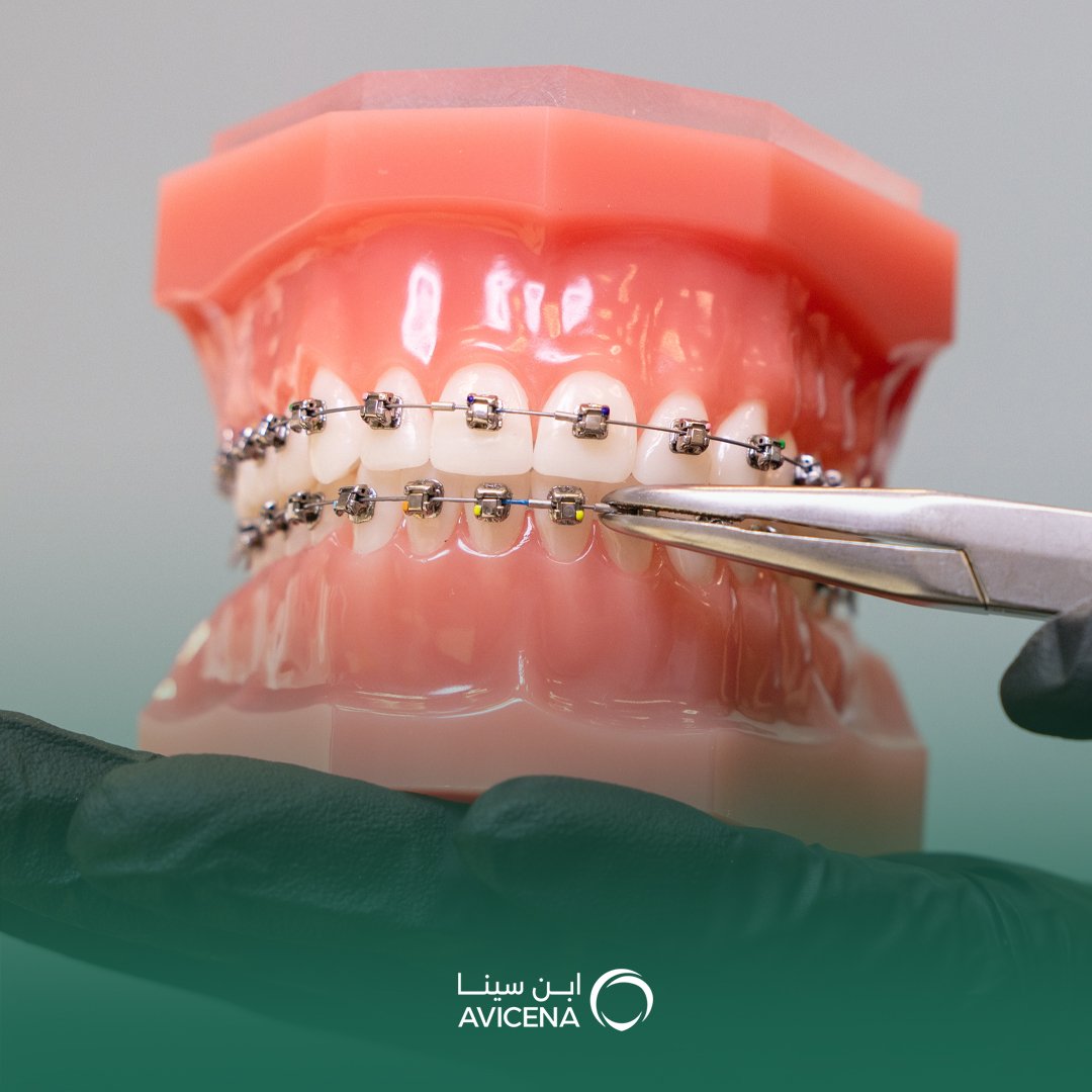 خبراء تقويم الأسنان في عيادات ابن سينا محتوى