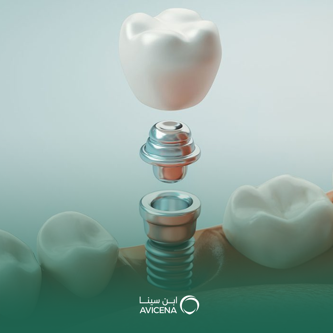 أحدث تقنيات زراعة الأسنان الفورية في السعودية