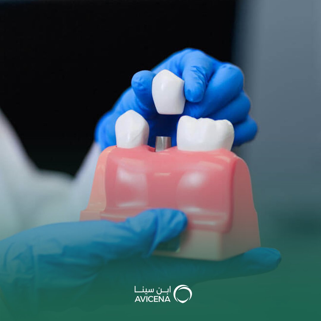 أفضل دكتور زراعة أسنان بالدمام