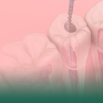 أفضل طبيب عصب أسنان بالميكروسكوب في الخبر