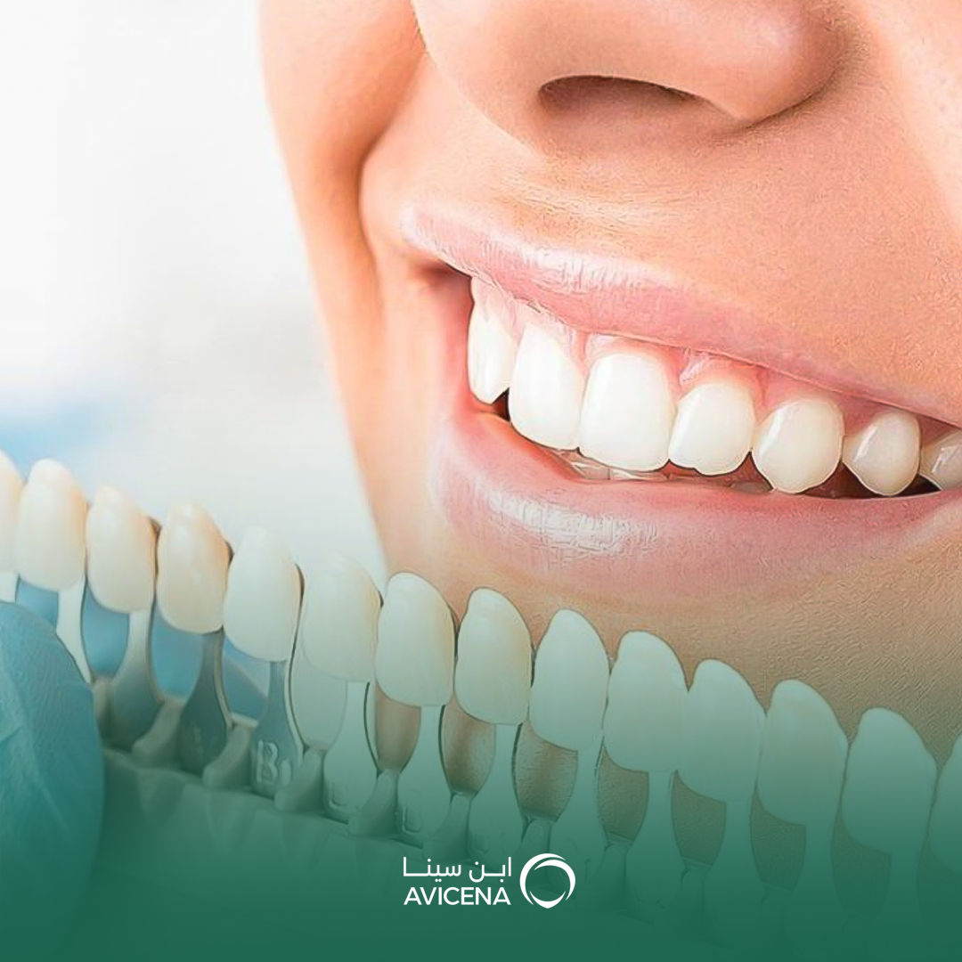 أفضل عيادة عدسات الأسنان في الخبر