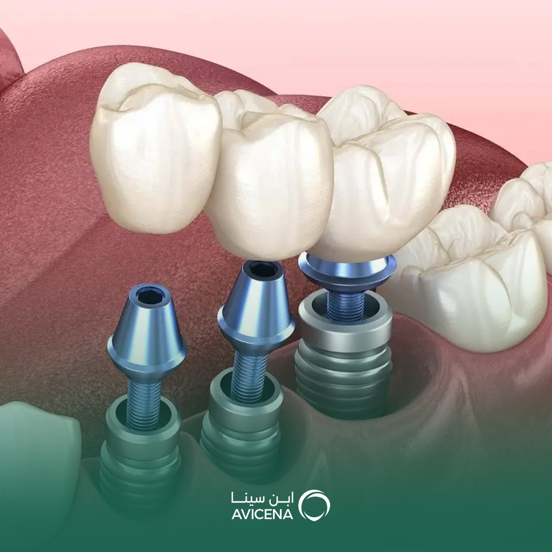 الفرق بين الزراعة التقليدية والفورية للأسنان