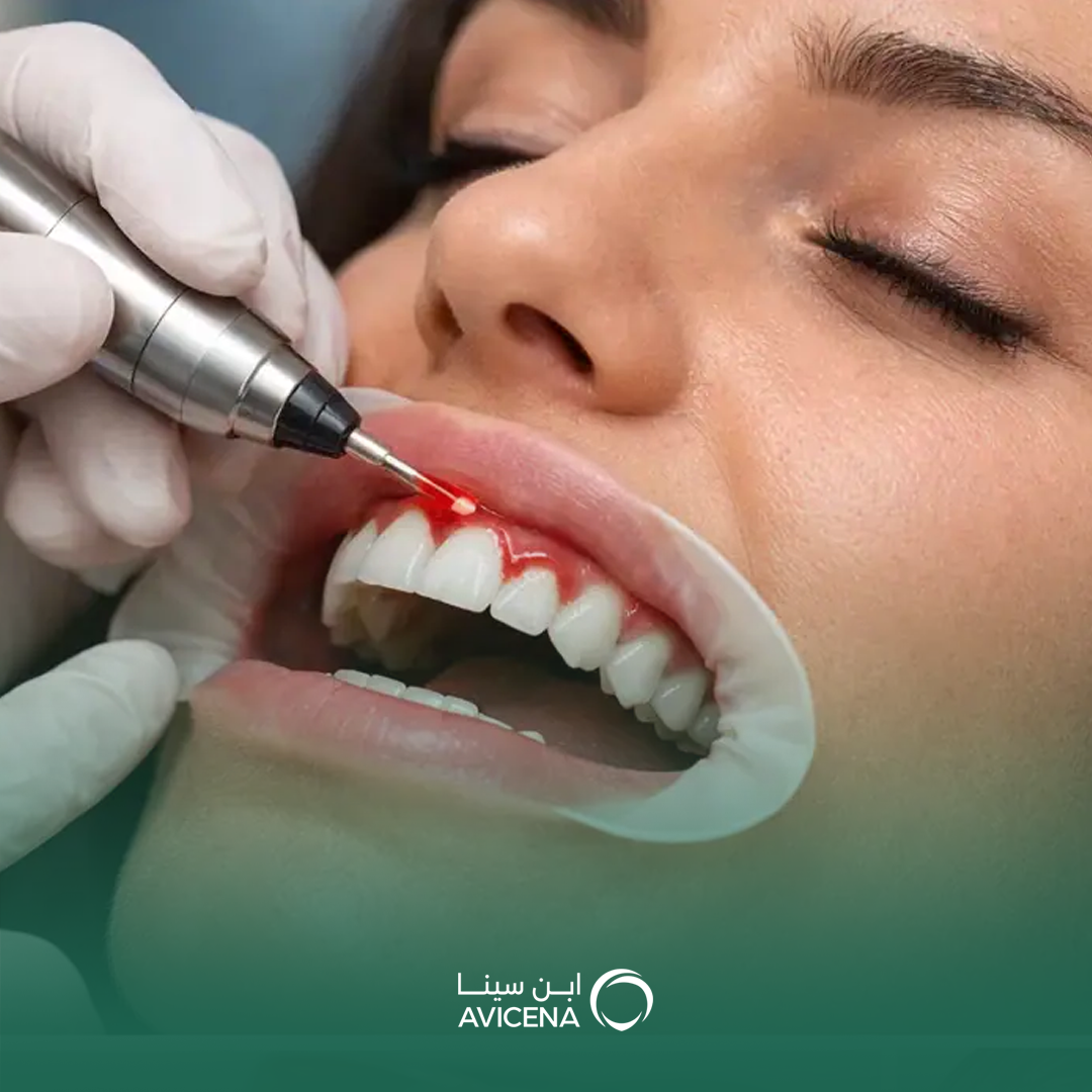 علاج اللثة بالليزر في الخبر