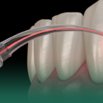 دليلك الشامل حول علاج اللثة بالليزر في الخبر: الفوائد والنتائج والأسعار