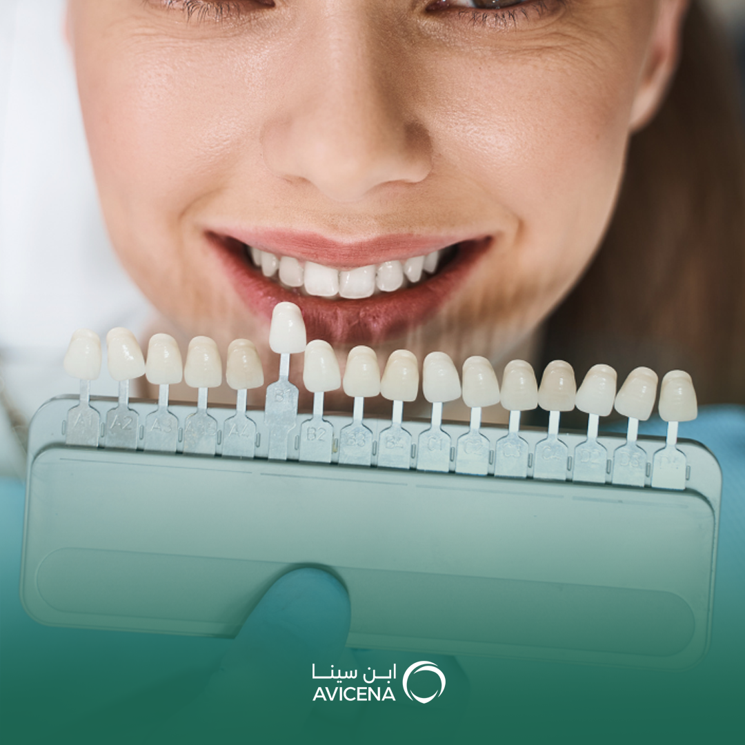 فينير الأسنان بدون حفر في السعودية