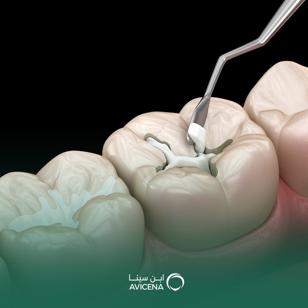 ما أفضل نوع حشوة أسنان تدوم طويلاً؟