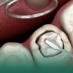 ما أفضل نوع حشوة أسنان تدوم طويلاً؟