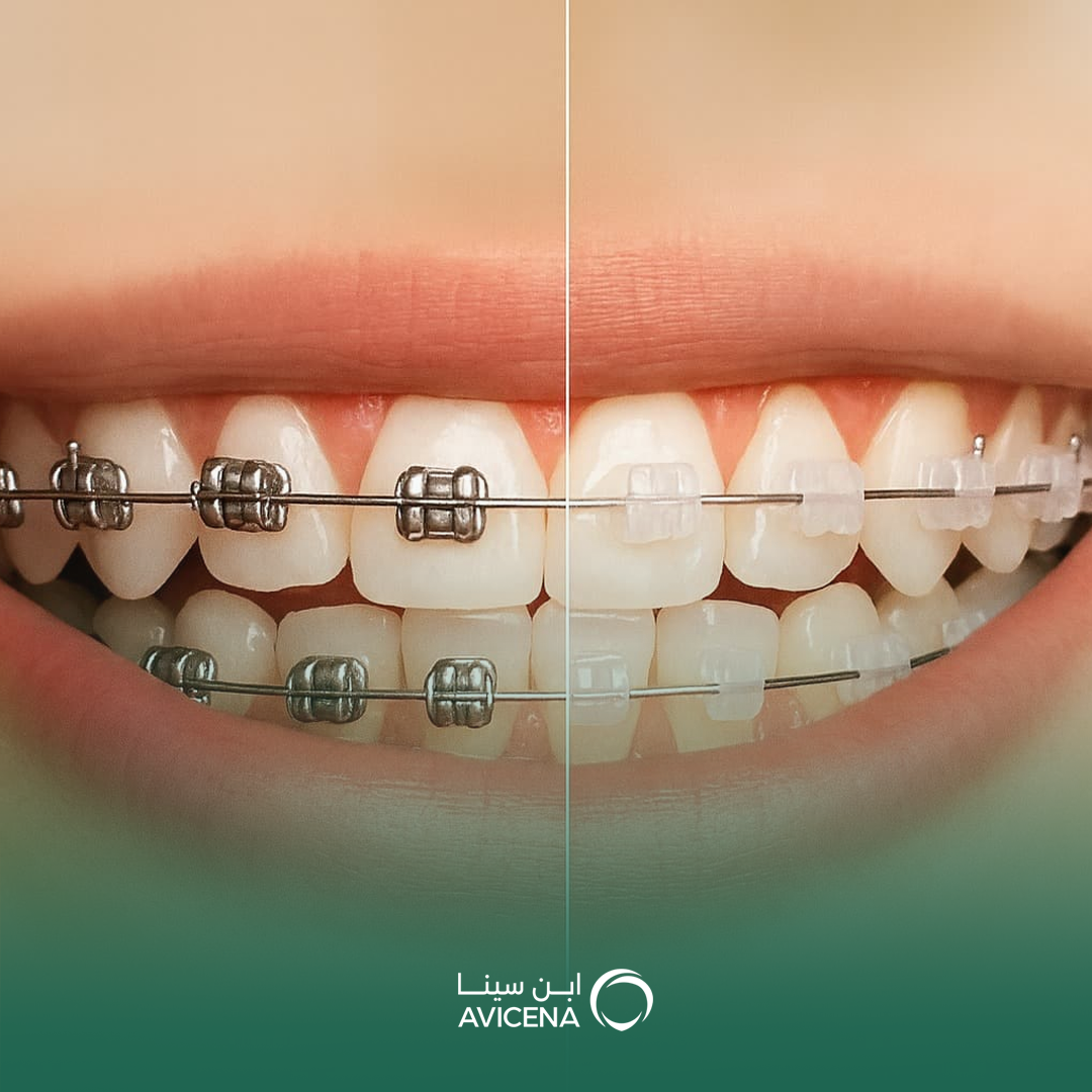 ما الفرق بين تقويم الأسنان المعدني والتقويم الشفاف؟