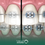 ما الفرق بين تقويم الأسنان المعدني والتقويم الشفاف؟