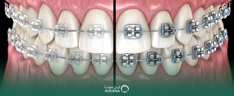 ما الفرق بين تقويم الأسنان المعدني والتقويم الشفاف؟