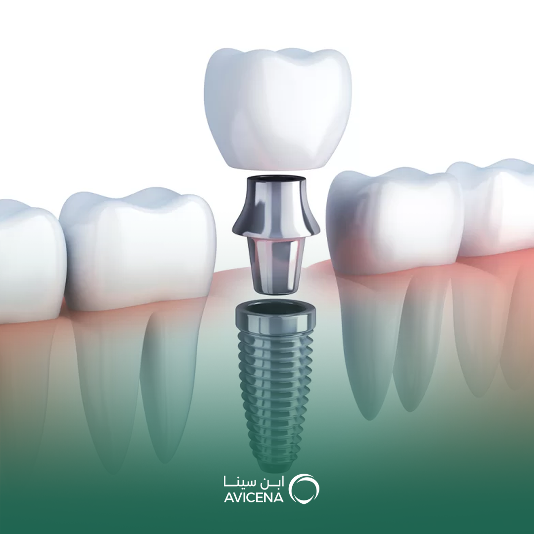 أنواع زراعة الأسنان المتاحة في الخبر
