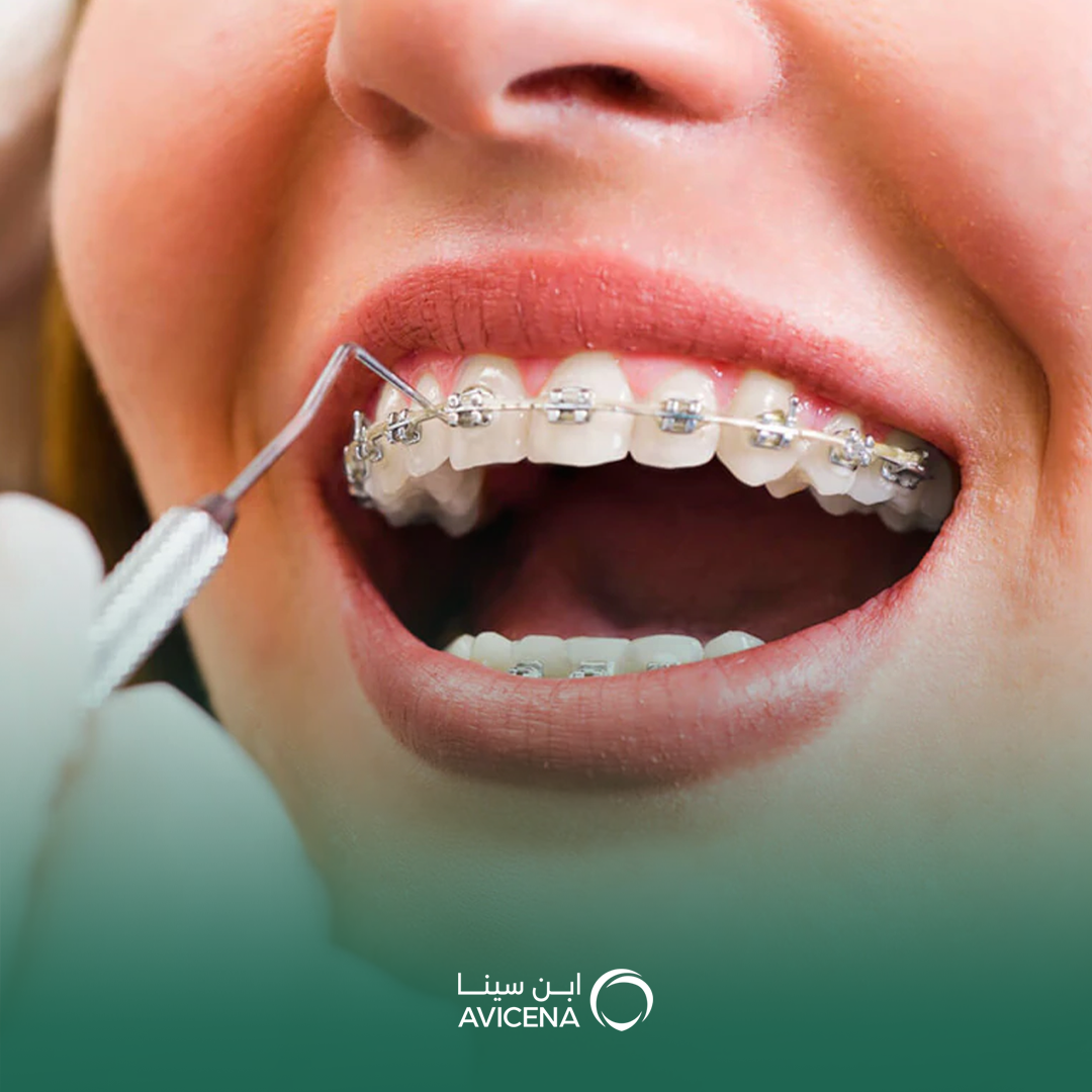 التقويم المعدني ذاتي الربط