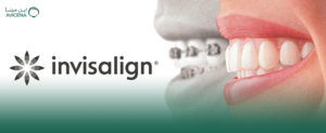 كل ما تريد معرفته عن تقويم الأسنان الشفاف انفزلاين في ابن سينا