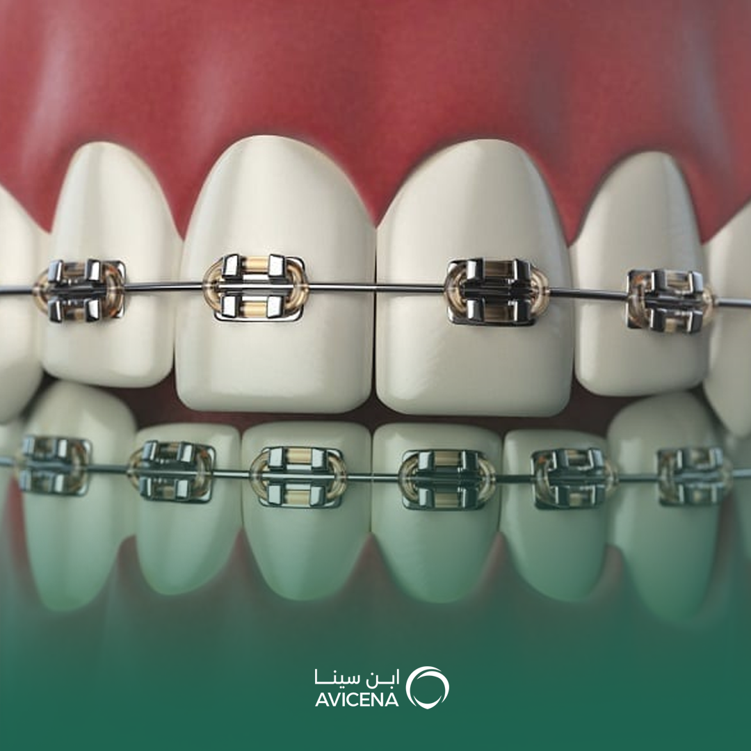 تكلفة تقويم الأسنان في الدمام