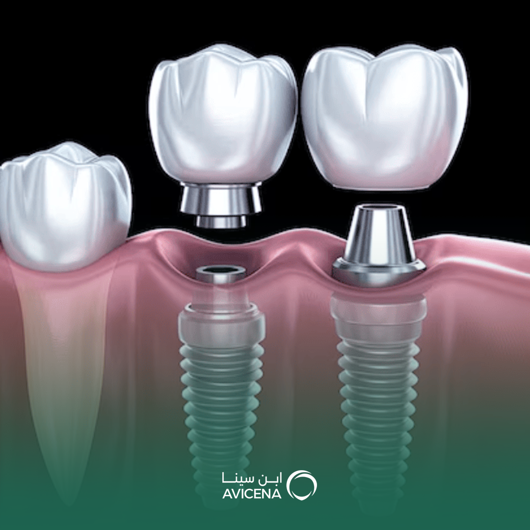 زراعة الأسنان في الدمام