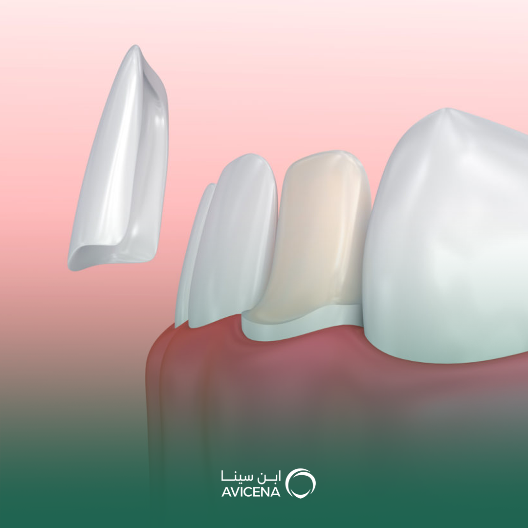 عدسات لاصقة للأسنان في الدمام