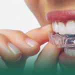 ما هي تكلفة تقويم الأسنان الشفاف Invisalign في الخبر؟
