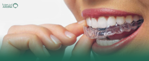 ما هي تكلفة تقويم الأسنان الشفاف Invisalign في الخبر؟