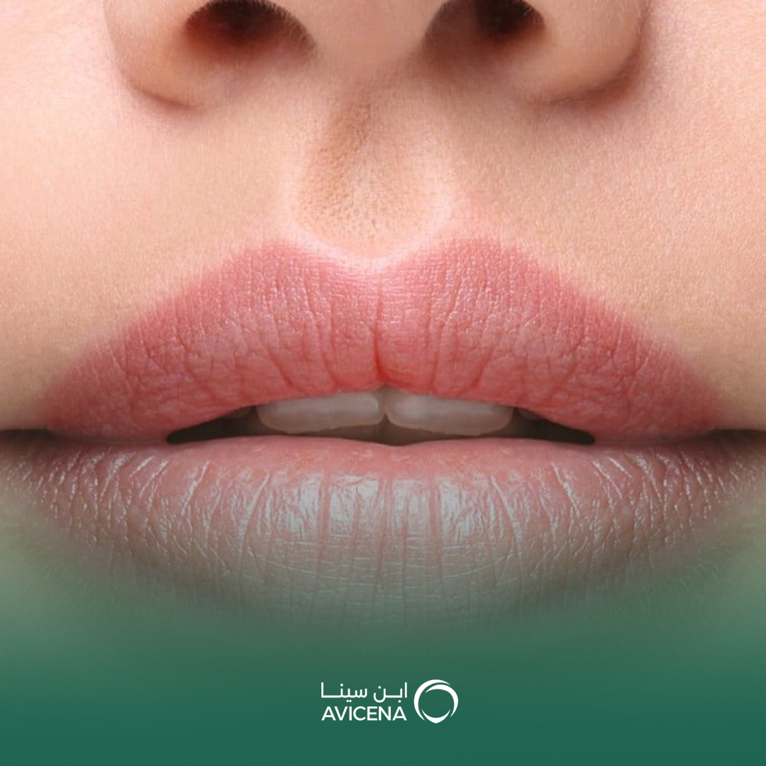 أفضل نوع فيلر للشفايف طبيعي