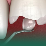 دليل شامل حول أنواع وعلاجات إصلاح الأسنان المكسورة والمضاعفات الناتجة