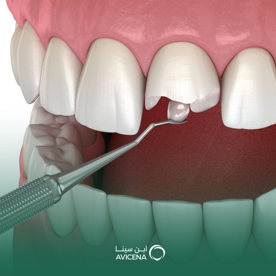 إصلاح الأسنان المكسورة