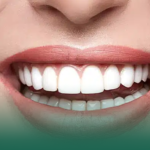 كيف تحصل على الابتسامة الهوليودية؟ التقنيات، الأنواع، وأفضل الاستشاريين