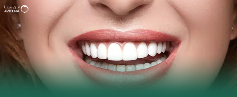 كيف تحصل على الابتسامة الهوليودية؟ التقنيات، الأنواع، وأفضل الاستشاريين