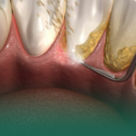 أهمية تنظيف الأسنان وإزالة الجير للوقاية من أمراض اللثة والتسوس