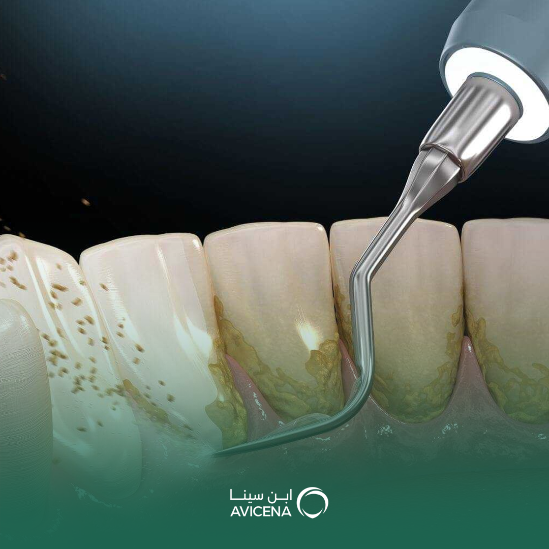 تنظيف الأسنان وإزالة الجير