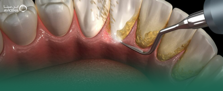 أهمية تنظيف الأسنان وإزالة الجير للوقاية من أمراض اللثة والتسوس