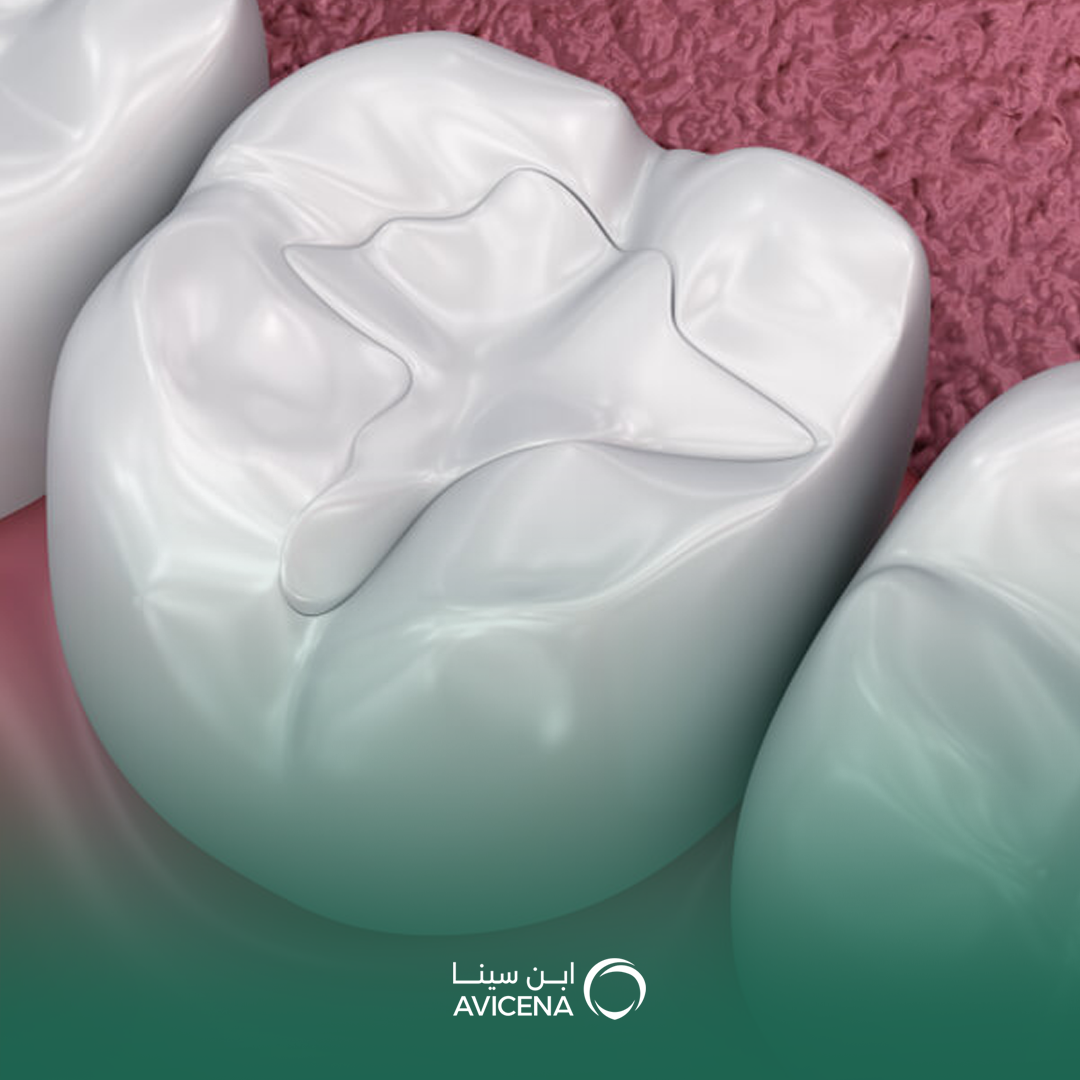 حشوات الأسنان التجميلية