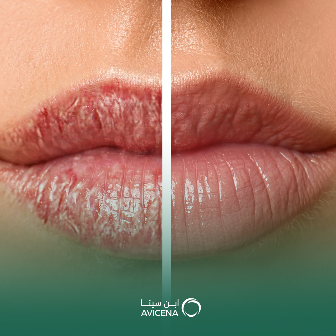 حقن Lip Booster للشفايف