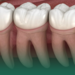 كل ما تريد معرفته عن خلع ضرس العقل الجراحي في عيادات ابن سينا