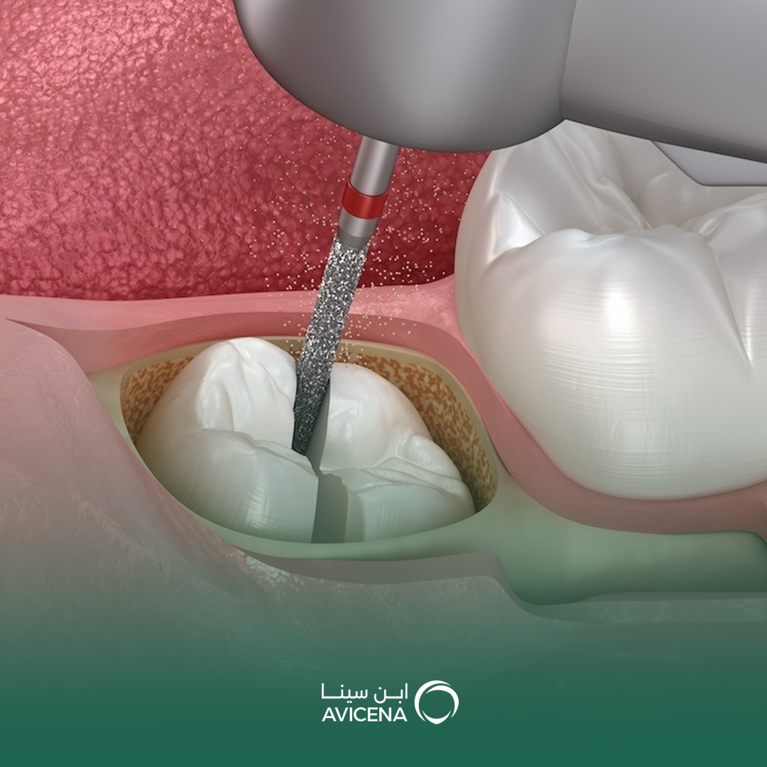 خلع ضرس العقل الجراحي