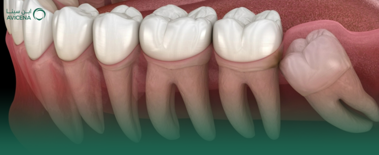 كل ما تريد معرفته عن خلع ضرس العقل الجراحي في عيادات ابن سينا